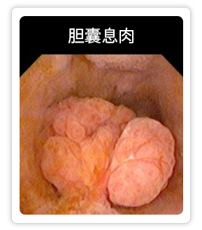 胆囊息肉.png
