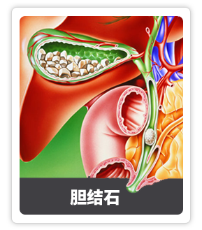 胆结石.png